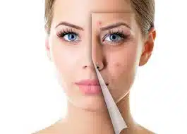 روتین پوست چرب